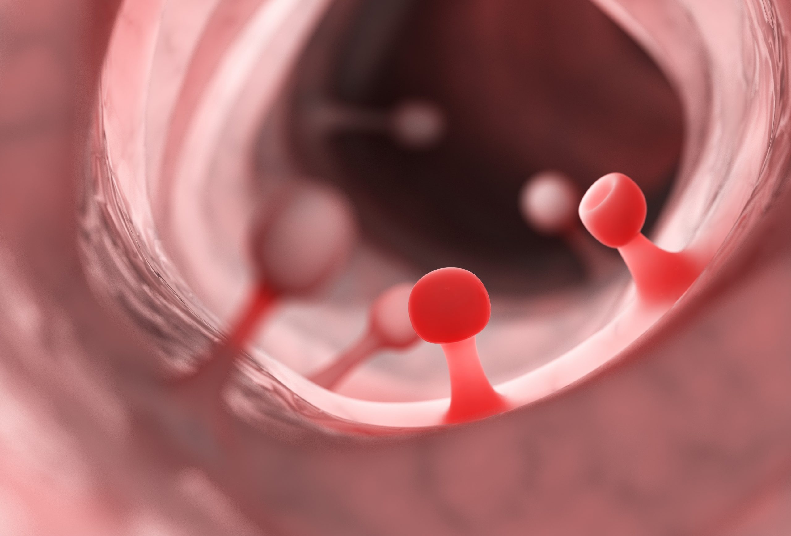 Polypen Formen, Diagnose, Therapie DocFinder Wissensmagazin